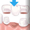 Zirconia Crowns