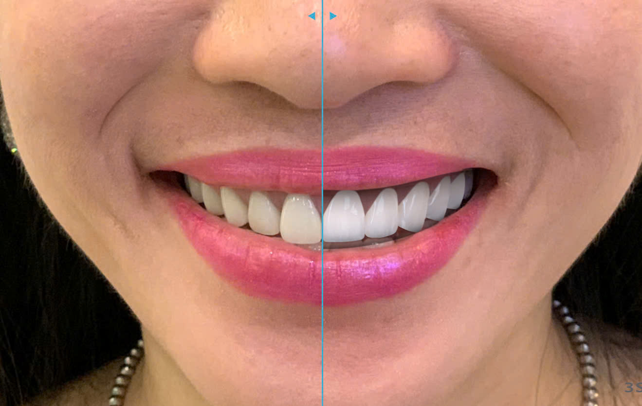 Digital Smile Design